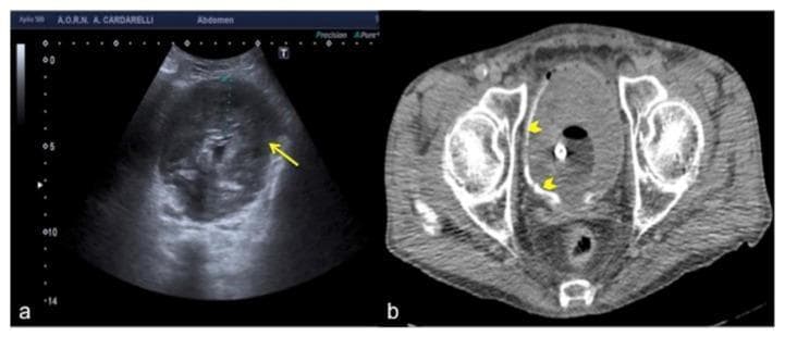 This dual-modality clinical imaging comparison presents a transverse ultrasound (US) scan and an axial Computed Tomography (CT) scan of the urinary bladder in a 78-year-old male presenting with hematuria. Image (a) is a transverse ultrasound showing a markedly distended bladder with diffuse, irregular wall thickening (indicated by a yellow arrow). The bladder lumen is filled with heterogeneous, low-to-medium level echoes, which can mimic a pseudo-mass or urothelial malignancy. Image (b) is a non-contrast axial CT scan of the same patient, revealing that the bladder lumen is entirely occupied by a large, hyperdense, homogenous mass (indicated by yellow arrowheads), identified as a massive intravesical blood clot. The CT scan clarifies the ultrasound findings by distinguishing the intraluminal clot from the true bladder wall. This comparison highlights a diagnostic pitfall where extensive blood clots can simulate bladder wall pathology or solid tumors on ultrasound. These images are clinically significant for emergency radiology and urology, illustrating the importance of cross-sectional imaging correlation in the workup of gross hematuria.
