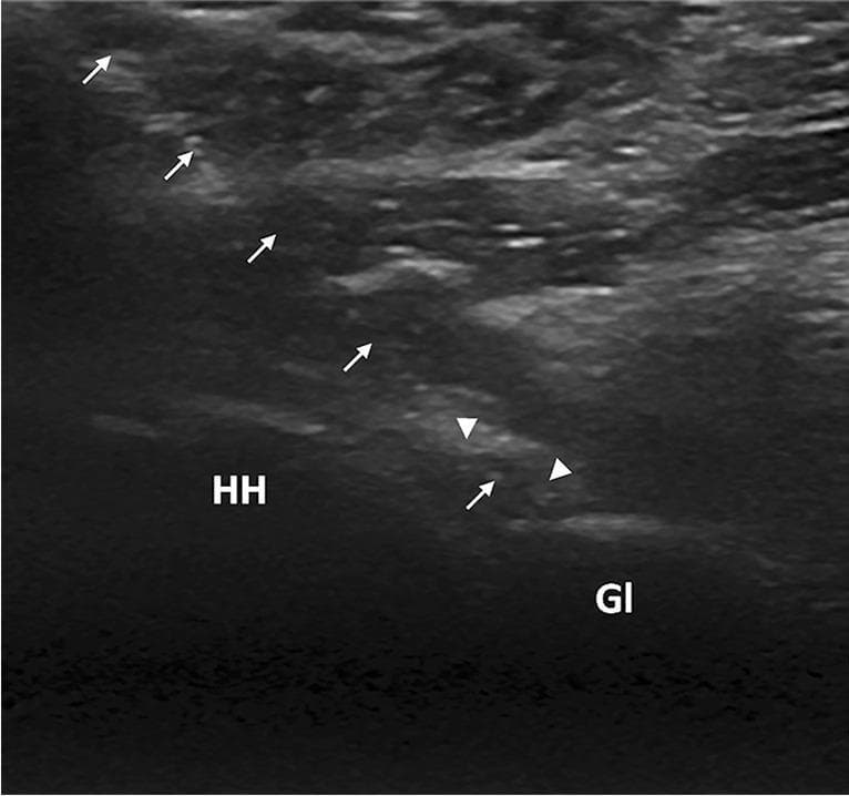 This diagnostic ultrasound image demonstrates a real-time, US-guided glenohumeral joint hydrodistension procedure using a posterior approach. The image shows the relevant musculoskeletal anatomy, including the humeral head (labeled HH) and the glenoid (labeled Gl). A needle is visualized as a hyperechoic linear structure, marked by white arrows, following a lateral-to-medial trajectory. The needle tip is correctly positioned within the glenohumeral joint space. Specifically, the tip terminates within the posterior joint recess, which is shown as a slightly distended, hypoechoic region indicated by white arrowheads. This visual illustrates the precise placement required for intra-articular injection in conditions like adhesive capsulitis (frozen shoulder). The imaging captures the interface between the bony articular surfaces and the joint capsule, highlighting the 'in-plane' needle technique used to monitor the depth and direction of the needle relative to the glenoid labrum and humeral cartilage.