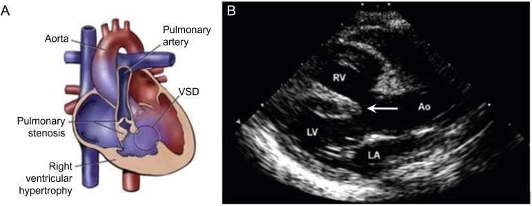 This composite educational graphic illustrates the pathophysiology and diagnostic imaging of Tetralogy of Fallot (TOF). Panel A is an anatomical diagram depicting the four hallmark features of TOF: a large ventricular septal defect (VSD), pulmonary stenosis (subvalvular and valvular), right ventricular hypertrophy with a thickened muscular wall, and an overriding aorta that sits above the septal defect, receiving blood from both ventricles. Panel B is a diagnostic 2D echocardiogram in a parasternal long-axis view. It confirms the clinical findings illustrated in Panel A, showing the right ventricle (RV) situated superiorly and the left ventricle (LV) inferiorly. A prominent white arrow points to the large malaligned VSD. The aorta (Ao) is clearly visualized overriding the interventricular septum, demonstrating its communication with both the LV and RV. The left atrium (LA) is seen posterior to the LV. The image serves as a clinical correlation between conceptual cardiac defects and their real-time ultrasound presentation.
