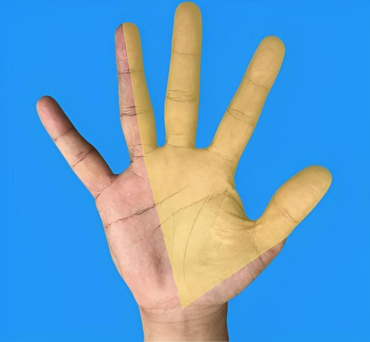 This clinical photograph/anatomical diagram hybrid illustrates the sensory distribution of the median nerve on the palmar surface of the right hand. The image displays a human hand against a blue background with a translucent yellow overlay highlighting the specific anatomical region innervated by the median nerve. The highlighted area covers the palmar aspect of the thumb (first digit), index finger (second digit), middle finger (third digit), and the radial half of the ring finger (fourth digit). The boundary line bisects the ring finger longitudinally and extends proximally across the palm toward the wrist, excluding the ulnar-innervated territory of the fifth digit and the ulnar half of the fourth. This visual is an essential educational tool for understanding peripheral nerve entrapment syndromes, specifically Carpal Tunnel Syndrome (CTS), as it clearly demonstrates the regions where patients typically experience paresthesia, numbness, or pain. It serves as a diagnostic reference for clinicians and medical students to correlate physical symptoms with nerve anatomy.
