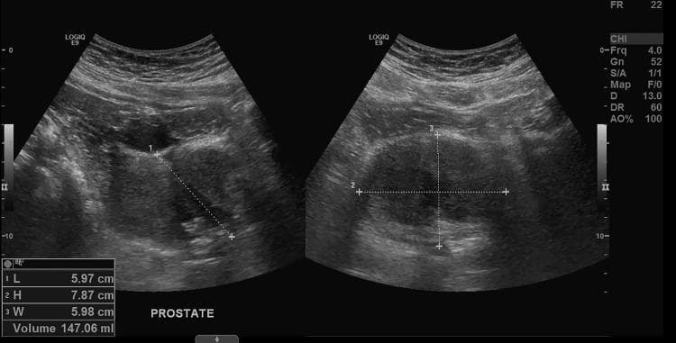 This diagnostic image is a split-screen retroperitoneal ultrasound of the prostate gland in longitudinal and transverse planes. The ultrasound shows severe prostatic enlargement (prostatomegaly) with a calculated volume of 147.06 mL, significantly exceeding the normal range. In the sagittal view (left), there is evidence of median lobe hypertrophy protruding into the bladder base. Electronic calipers measure the gland's dimensions: length (L) 5.97 cm, height (H) 7.87 cm, and width (W) 5.98 cm. The prostate displays a relatively heterogeneous but primarily hypoechoic to isoechoic echotexture with well-defined borders. This imaging is clinically significant for evaluating benign prostatic hyperplasia (BPH) and lower urinary tract symptoms. The presence of median lobe hypertrophy is a key finding that can contribute to bladder outlet obstruction. The image is intended for intermediate to advanced medical learners studying urology and diagnostic radiology.