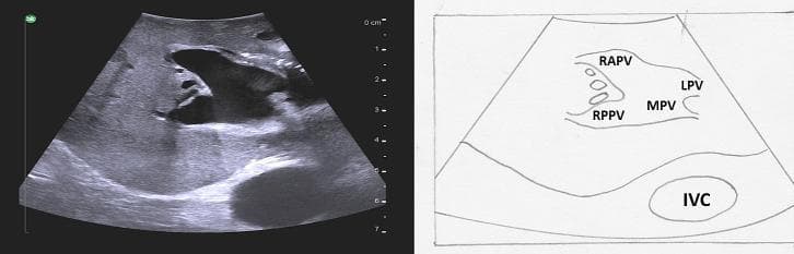 This diagnostic visual includes a B-mode grayscale ultrasound image and a corresponding labeled line diagram illustrating a portal vein trifurcation, an anatomical variant of the liver. The image demonstrates the main portal vein (MPV) dividing simultaneously at a single point into three branches: the left portal vein (LPV), the right anterior portal vein (RAPV), and the right posterior portal vein (RPPV), indicating the absence of a common right portal vein trunk. The vascular structures exhibit characteristic hyperechoic walls due to Glisson's capsule and are surrounded by homogeneous, medium-echogenicity liver parenchyma. Posterior and inferior to the portal confluence, the inferior vena cava (IVC) is visible as an anechoic oval structure. This content is intended for surgical planning and radiological education, highlighting variations in hilar anatomy crucial for performing segmentectomies or hepatic resections. The labels facilitate identification of segmental portal supply in the context of intraoperative or diagnostic ultrasound.