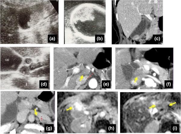 Multi-modal diagnostic imaging of a gallbladder mass and associated lymphadenopathy. (a-b) Ultrasonography (US) images reveal a highly echoic, sessile mass measuring approximately 30 mm in the gallbladder fundus. Intraoperative US (b) demonstrates preservation of the hyperechoic outer layer, suggesting a 'Type B' tumor depth limited to the muscularis propria. (c) Sagittal CT reconstruction confirms the intraluminal gallbladder mass without gross invasion into the hepatic parenchyma. (d-g) Abdominal US and axial CT scans identify multiple swollen lymph nodes (labeled 'N' or indicated by arrows) located within the hepatoduodenal ligament and para-aortic regions. (h-i) Diffusion-Weighted Imaging (DWI) highlights a significant signal intensity discordance: the gallbladder mass exhibits marked hyperintensity, while the enlarged lymph nodes appear hypointense. These images illustrate the diagnostic workflow for staging gallbladder carcinoma and differentiating between metastatic involvement and benign lymphadenopathy (e.g., sarcoid-like reactions) using signal intensity patterns on MRI.