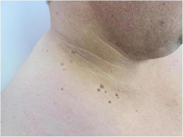 This clinical photograph displays a lateral view of a patient's neck and upper shoulder, demonstrating classic dermatological manifestations of insulin resistance. Centered on the lateral and posterior neck folds are poorly defined, symmetrical, velvety hyperpigmented plaques characteristic of acanthosis nigricans. The affected skin shows a brownish-tan discoloration with a prominent thickened, verrucous (wart-like) texture following the natural skin lines. Distributed within and adjacent to these hyperpigmented areas are multiple fibroma pendula (skin tags or acrochordons). These are small, skin-colored to slightly hyperpigmented, pedunculated papules. The educational focus of this image is the visual identification of metabolic-related skin changes commonly associated with obesity, hyperinsulinemia, and type 2 diabetes mellitus. The co-occurrence of acanthosis nigricans and multiple acrochordons in intertriginous areas is a significant clinical indicator for underlying metabolic syndrome.