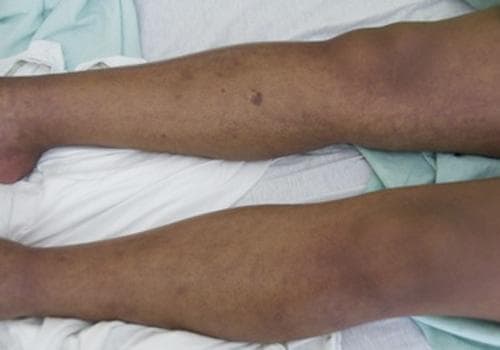 This clinical photograph displays the lower extremities of a patient exhibiting a diffuse, non-blanching purpuric rash. The lesions are characterized by a wide distribution of erythematous to violaceous macules and patches across both legs, including the shins and thighs. The morphology consists primarily of small petechiae and larger ecchymotic areas, with some regions showing confluent purpura. A notable, isolated round purpuric lesion is visible on the anterior surface of the upper lower leg. The skin texture appears generally intact without evidence of edema, ulceration, or necrosis, though some areas exhibit mild xerosis. Clinically, this presentation is consistent with a systemic hemorrhagic process or vasculopathy, often associated with infectious diseases such as Dengue fever (Dengue Hemorrhagic Fever), meningococcemia, or hematological conditions like thrombocytopenia. This image serves as an educational tool for identifying purpura in diverse skin tones and recognizing cutaneous manifestations of systemic viral or bacterial infections.