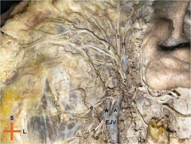 This clinical photograph displays a cadaveric dissection of the left extratemporal facial nerve (Cranial Nerve VII), highlighting its complex branching pattern and vascular relationships. The main trunk bifurcates into the temporofacial and cervicofacial divisions. The superior temporofacial division gives rise to the temporal and zygomatic branches, which course toward the upper face, and a buccal branch. The inferior cervicofacial division exhibits a rare anatomical variation where it bifurcates around the posterior facial vein; the upper branch passes superficially while the lower branch courses deep to the vein. Key anatomical landmarks include the retromandibular vein, the external jugular vein (EJV), and the masseter muscle. Labeled structures include the temporal (4), zygomatic (5), buccal (6), and marginal mandibular (8, 9) branches. This image is an essential educational resource for surgical anatomy, particularly for parotidectomy and maxillofacial procedures, demonstrating the critical proximity of neural branches to venous structures in the parotid region.