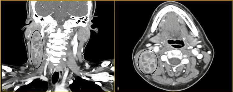 This diagnostic image is a contrast-enhanced computerized tomography (CT) scan of the neck presented in two planes: a coronal section (A) and a transverse (axial) section (B). Both views highlight a large, glomerate lymph node mass in the right cervical region, measuring approximately 4.2 x 7.4 cm, indicated by black ovals. The mass is characterized by its hypoattenuating appearance relative to surrounding musculature, containing multiple internal low-density areas consistent with central necrosis or cystic degeneration. Anatomically, the coronal view shows the mass extending vertically along the right lateral neck, superficial to the cervical spine. The transverse view demonstrates the mass situated lateral to the vertebral column and posterior to the oropharynx, maintaining relatively well-defined borders with adjacent soft tissues. This finding is characteristic of significant cervical lymphadenopathy, frequently seen in infectious processes like tuberculosis (scrofula) or metastatic malignancy. The image is intended for medical students and clinicians to learn the radiological presentation of necrotic lymph nodes and the relevant anatomy of the neck compartments.