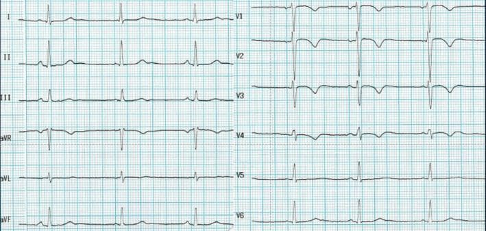 A 12-lead electrocardiogram (ECG) demonstrating a classic presentation of arrhythmogenic cardiomyopathy (AC) in a young athlete. The most significant finding is the presence of deep, symmetric T-wave inversions (TWI) in the right precordial leads, extending from V1 through V4. These inversions are most prominent in V2 and V3. The limb leads (I, II, III, aVL, and aVF) show generally upright QRS complexes and T-waves, while lead aVR shows expected global inversion. There is no evidence of complete right bundle branch block (QRS < 120 ms). The primary clinical significance of this ECG pattern is its recognition as a major diagnostic criterion for arrhythmogenic cardiomyopathy, especially when identified during pre-participation screenings for athletes. This visual serves as an educational reference for distinguishing pathologic anterior T-wave inversions from benign athletic adaptations, which typically lack this degree of precordial extension and depth.