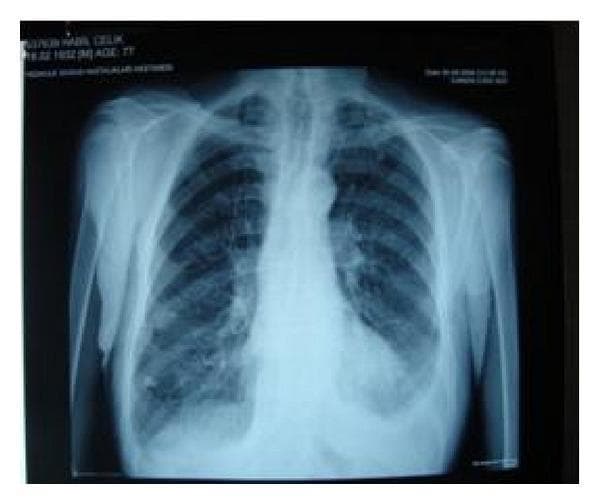 This diagnostic image is a posteroanterior (PA) chest radiograph demonstrating bilateral lung parenchyma with signs of chronic obstructive pulmonary disease (COPD) and emphysema. Key findings include increased lung translucency and hyperinflation, evidenced by flattened diaphragmatic contours and a vertically oriented heart silhouette. The image shows the chest following treatment for a prior right-sided pneumothorax, with current findings indicating complete lung re-expansion and the absence of any visible pleural air collection or active pneumothorax. The mediastinum is midline, and the costophrenic angles appear clear. This radiograph serves as an educational example of treatment follow-up for refractory air leaks in patients with severe emphysematous changes and comorbidities, where surgical intervention was contraindicated. Notable features include the prominent pulmonary vasculature and diffuse parenchymal rarefaction consistent with advanced emphysema.