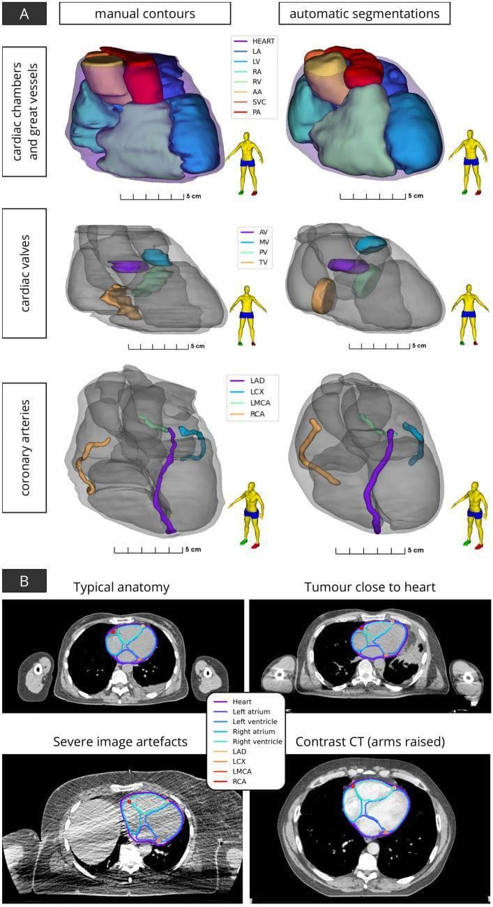 This composite educational graphic illustrates cardiac anatomy segmentation for radiotherapy planning. Section A presents three-dimensional surface renderings comparing manual contours and automatic segmentations across three tiers: cardiac chambers and great vessels (LA, LV, RA, RV, AA, SVC, PA), cardiac valves (AV, MV, PV, TV), and coronary arteries (LAD, LCX, LMCA, RCA). Each rendering highlights spatial relationships between chambers and vessels, with human figure icons indicating anatomical orientation. Section B displays axial computed tomography (CT) slices demonstrating the application of automatic segmentation algorithms in diverse clinical scenarios: 'Typical anatomy', 'Tumour close to heart', 'Severe image artefacts', and 'Contrast CT (arms raised)'. The segmentations delineate the heart, atria, ventricles, and coronary vessels, showing the model's robustness to anatomical variations and imaging challenges common in thoracic oncology. This visualization highlights the clinical utility of deep learning and multi-atlas mapping for accurate cardiac substructure identification in dose-response studies and cardiac-sparing radiotherapy.