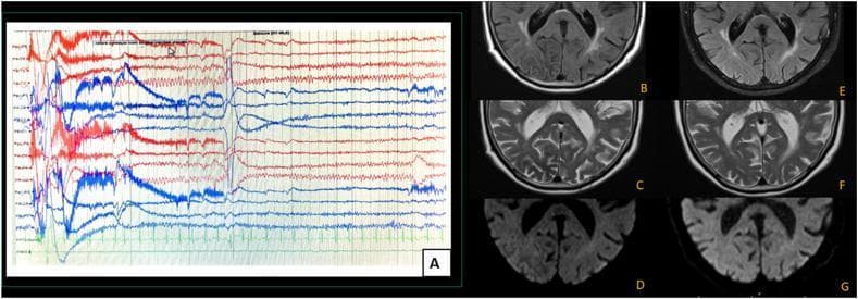 This composite image includes a diagnostic electroencephalogram (EEG) and axial brain MRI sequences demonstrating ictal activity and its corresponding neuroimaging evolution. Panel A shows an ictal EEG with high-amplitude sharp discharges and background slowing localized to the right occipital region, consistent with focal seizure activity. Panels B, C, and D display initial MRI findings in the axial plane: a decreased signal intensity in the right middle occipital cortex is visible on Fluid-Attenuated Inversion Recovery (FLAIR, B) and T2-weighted (C) imaging, while Diffusion-Weighted Imaging (DWI, D) shows hyperintensity, often referred to as a cortical sign. Panels E, F, and G show follow-up MRI sequences in the same order (FLAIR, T2, and DWI), documenting complete resolution of the previously seen signal abnormalities. This visual progression illustrates the correlation between focal occipital seizures and transient, reversible cortical signal changes on MRI, often associated with metabolic disturbances like non-ketotic hyperglycemia.