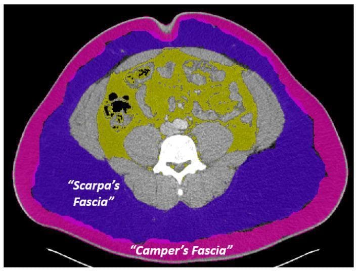 This diagnostic image is an axial computed tomography (CT) scan of the abdomen at the level of the umbilicus, utilizing color-coded overlays to delineate superficial and deep adipose compartments. The image serves as an anatomical diagram for differentiating abdominal wall layers. The outermost layer, highlighted with a pink overlay, represents Camper's fascia (superficial subcutaneous adipose tissue), appearing as a contiguous fatty layer immediately deep to the skin. Internal to this is the purple overlay designating Scarpa's fascia (deep subcutaneous adipose tissue), which is separated from the deeper visceral fat by the abdominal musculature. The yellow overlay identifies the visceral fat (intra-abdominal fat), which is distributed irregularly within the peritoneal cavity, interspersed between and surrounding internal organs and the vertebral body. This visualization emphasizes the spatial relationship between subcutaneous and visceral adipose depots, illustrating clinical concepts related to body composition analysis, metabolic health, and surgical anatomy of the abdominal wall.