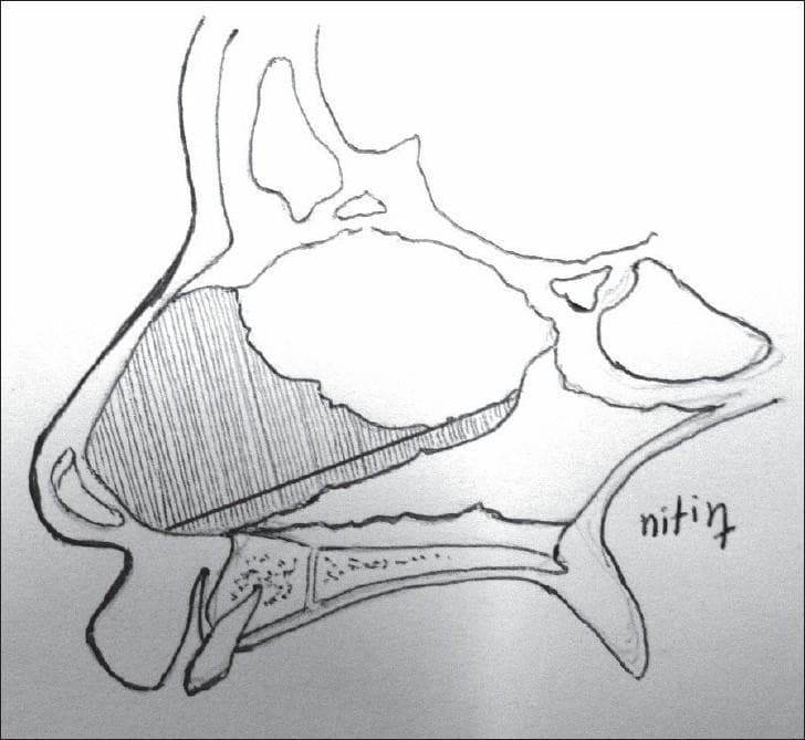 This medical anatomical diagram provides a sagittal cross-section of the human nasal region, specifically illustrating the surgical site for a septal cartilage graft harvest. Key landmarks include the nasal bones superiorly, the anterior nasal spine, and the alveolar ridge and hard palate inferiorly. The central focus is the cartilaginous nasal septum. A diagonal shaded area indicates the precise donor site for harvesting septal cartilage. This area encompasses the lower and anterior portions of the quadrangular cartilage, extending posteriorly along the floor of the nasal cavity towards the vomerine attachment but leaving a superior and anterior 'L-strut' for structural support. The diagram is designed for educational use in plastic and reconstructive surgery, specifically for procedures such as cleft lip rhinoplasty or secondary rhinoplasty where autologous cartilage is required for columellar struts or tip projection.