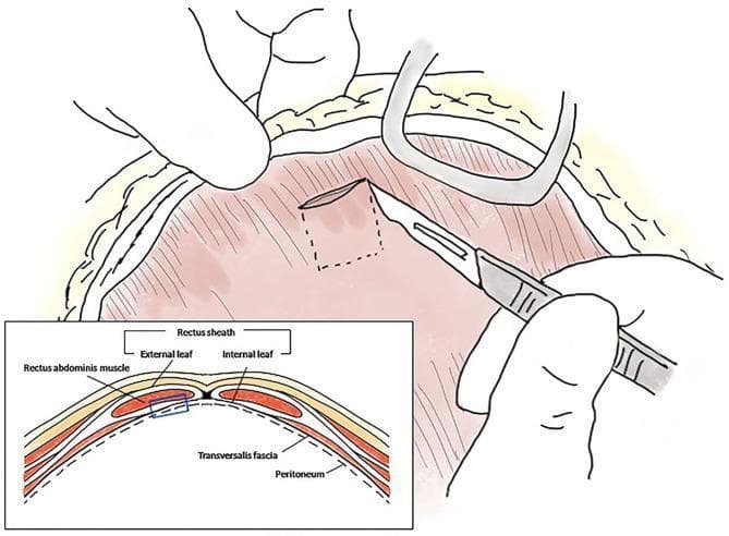 This medical illustration depicts the surgical harvesting of an autologous rectus sheath graft, combining a primary surgical field diagram and an anatomical cross-section. The main illustration shows a surgeon's hands performing a coeliotomy, using a scalpel to incise the internal leaf of the rectus sheath. A dashed square indicates the planned 1 x 1 cm graft harvest site. Retractors are shown maintaining the abdominal incision. The bottom-left inset provides a schematic cross-sectional view of the abdominal wall layers, labeled from superficial to deep: external leaf of the rectus sheath, rectus abdominis muscle, internal leaf of the rectus sheath, transversalis fascia, and peritoneum. A blue highlighted box in the cross-section correlates with the surgical site, specifically identifying the internal leaf and underlying peritoneum as the tissue layers being harvested. This visual serves to educate on surgical anatomy and the technique for obtaining autologous tissue for reconstructive procedures, such as gallbladder or common bile duct repair.