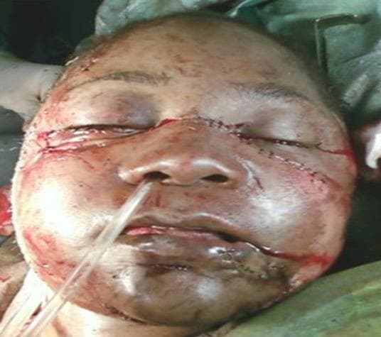 This clinical photograph shows the immediate postoperative appearance of a patient following complex maxillofacial reconstructive surgery for severe facial trauma. The image demonstrates extensive surgical intervention across the midface and mandible. Key findings include bilateral periorbital and palpebral edema with primary suture lines along the lower eyelids and canthus, indicating soft tissue and possibly orbital floor repair. Multiple surgical incisions are visible, closed with simple interrupted and continuous sutures, extending across the nasal bridge, cheeks, and perioral region. Significant ecchymosis and generalized facial swelling are present, typical of high-impact craniofacial injury. A nasogastric or endotracheal tube is visible exiting the naris, used for perioperative management. The reconstruction addresses multiple midface and mandibular fractures (such as Le Fort I/III and symphyseal fractures) through soft tissue debridement and anatomical repositioning. This visual serves as an educational example of emergency maxillofacial trauma management and primary surgical closure of complex facial lacerations.