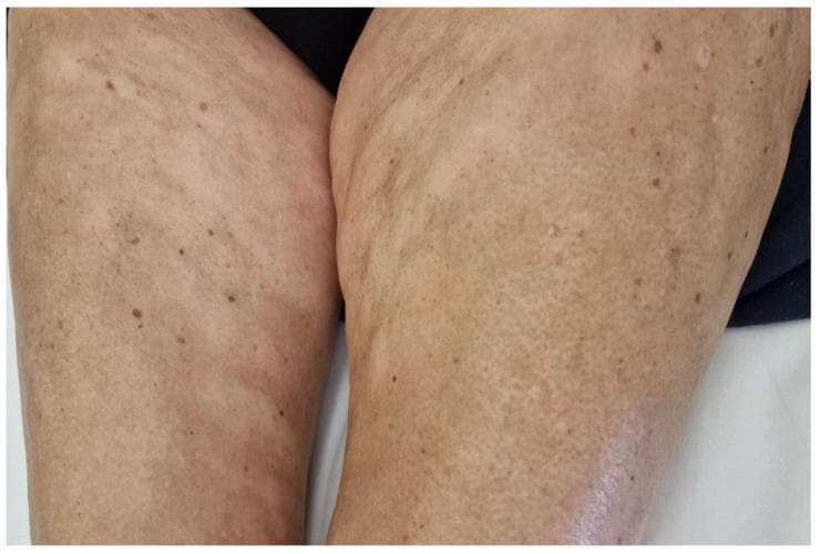 This clinical photograph displays the inner thighs of a patient exhibiting signs of plaque-type morphea, a localized form of scleroderma. The skin demonstrates significant morphological changes, characterized by multiple hypopigmented, ivory-colored plaques. These lesions are primarily round to oval, varying in size, with some appearing as isolated spots while others have coalesced into larger, irregularly shaped patches. The surface texture of the affected skin shows subtle central induration and unevenness, consistent with cutaneous sclerosis. In addition to the large hypopigmented regions, there are scattered small, hyperpigmented macules and nevi throughout the field. The distribution is bilateral and asymmetric. This visual serves as an educational example of localized scleroderma (morphea) in the context of systemic conditions like monoclonal gammopathy, illustrating characteristic central whiteness and loss of normal skin texture within active or chronic plaques.