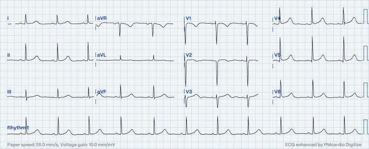 A standard 12-lead electrocardiogram (ECG) displayed on a grid with a paper speed of 25.0 mm/s and a voltage gain of 10.0 mm/mV. The tracing demonstrates a regular sinus rhythm with a physiologic heart rate. Distinct P waves are visible before every QRS complex, indicating a 1:1 atrioventricular conduction with a normal PR interval. The limb leads (I, II, III, aVR, aVL, aVF) show upright P and T waves in leads I and II, with a predominantly positive QRS in lead II consistent with a normal cardiac axis. The precordial leads (V1-V6) exhibit characteristic R-wave progression, transitioning from a small R-wave and deep S-wave in V1-V2 to a tall R-wave and minimal S-wave in V5-V6. No acute ST-segment elevations or T-wave inversions are present, signifying a resolution of previous conduction disturbances such as pseudo-Mobitz type II AV block. This diagnostic image serves as an educational example of a normal resting 12-lead ECG post-clinical intervention.