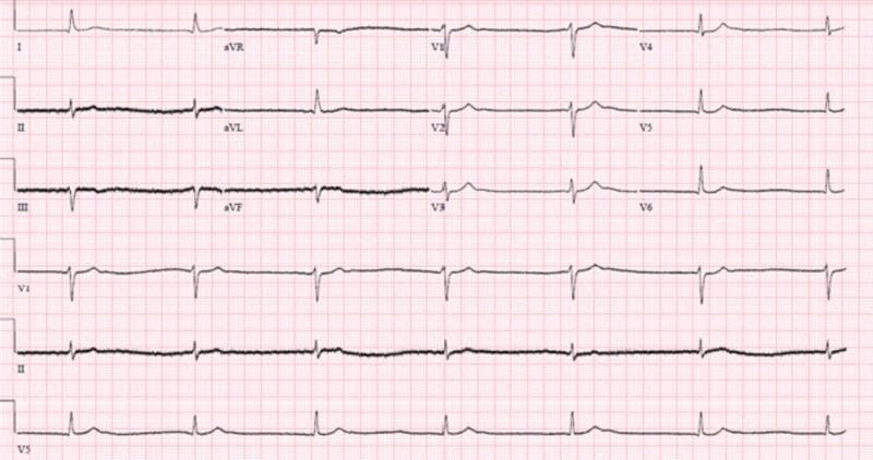 This diagnostic image is a 12-lead electrocardiogram (ECG) demonstrating junctional bradycardia. The tracing shows a slow, regular ventricular rate with narrow QRS complexes (duration within normal limits, <120 ms). A key diagnostic feature is the absence of clear, consistent sinus P waves preceding each QRS complex, suggesting an escape rhythm originating from the atrioventricular junction. In some leads, such as II and aVF, P waves are either absent or dissociated, consistent with the clinical context of a progressive bradyarrhythmia. The precordial leads (V1-V6) show preserved R-wave progression. There is no evidence of acute ST-segment elevation or significant T-wave inversions. This ECG illustrates a junctional escape rhythm, which may occur in the setting of sinus node dysfunction, high-grade AV block, or metabolic disturbances. The educational focus is on identifying non-sinus bradycardias and distinguishing junctional rhythms by their narrow QRS morphology and lack of preceding P waves.