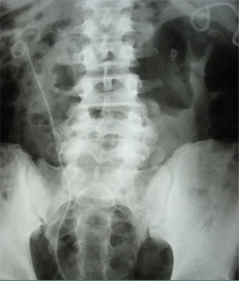 Anteroposterior KUB (kidneys, ureters, and bladder) radiograph of the abdomen and pelvis. The imaging demonstrates the lumbar spine, sacrum, and iliac crests with visible bowel gas patterns. Two distinct medical devices are present: a percutaneous nephrostomy (PCN) tube and a double-J ureteral stent. On the patient's left side, a radiopaque catheter is visible, originating from the flank and terminating in a pigtail-shaped coil in the upper left quadrant, consistent with a percutaneous nephrostomy placement for renal decompression. Concurrently, a double-J stent is visible on the patient's right side, with its proximal coil situated in the right renal pelvis and its distal end extending inferiorly through the ureter toward the bladder. This visual illustrates common urological interventions for managing urinary tract obstructions, such as those caused by urolithiasis, ureteral strictures, or malignancies. The radiograph is essential for confirming the correct anatomical positioning of these drainage devices relative to the renal and pelvic structures.