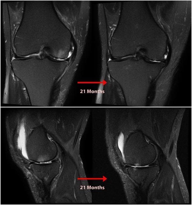This diagnostic comparison image consists of T2-weighted magnetic resonance (MR) images of the right knee in coronal (top row) and sagittal (bottom row) planes, illustrating the 21-month progression of post-traumatic osteoarthritis. The series demonstrates the clinical consequences of a nonanatomic posterior medial meniscus root repair (PMMRT). In the coronal view, there is progressive medial joint space narrowing and notable meniscal extrusion beyond the tibial margin. The sagittal view reveals advancing chondromalacia and cartilage thinning between the femoral condyle and tibial plateau. Associated findings include subchondral bone marrow edema and changes in subchondral bone density, particularly in the medial compartment. These images emphasize the importance of anatomic meniscal root restoration to maintain joint biomechanics and prevent rapid degenerative changes. The visual highlights a transition from early-stage pathology to more advanced secondary osteoarthritis characterized by loss of articular cartilage and joint space collapse.