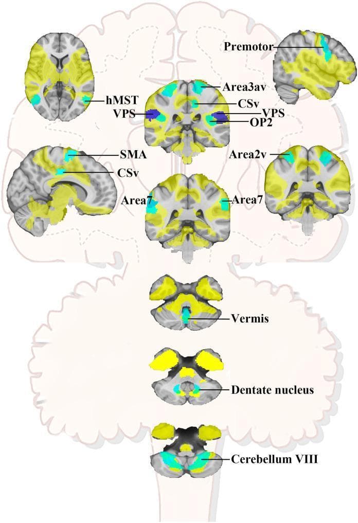 This medical schematic illustration depicts the lesion-based vertigo network across multiple neuroanatomical planes, including axial, sagittal, and coronal views of the brain and cerebellum. The diagram identifies key cortical and subcortical regions involved in vestibular processing and vertigo pathophysiology. Specific regions highlighted in teal and dark blue include the bilateral Area 2v (intraparietal sulcus), Area 3av (central sulcus fundus), Premotor cortex, Cingulate Sulcus Visual area (CSv), Supplementary Motor Area (SMA), and Area 7 (supramarginalis). Critical vestibular hubs such as the Visual Posterior Sylvian (VPS) or Posterior Insular Cortex (PIC) and Parietal Opercula 2 (OP2) are also marked. The lower sections focus on the vestibulocerebellum, highlighting the vermis, bilateral dentate nucleus, and cerebellum lobule VIII. This anatomical map serves as an educational tool for understanding the spatial distribution and connectivity of the functional network associated with acute vertigo following supratentorial or cerebellar lesions.