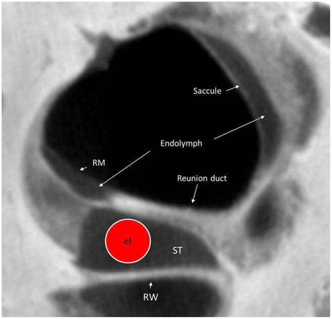 This diagnostic image is a high-resolution micro-computed tomography (micro-CT) cross-section of the human cochlear base, specifically focused on the round window (RW) region. The image illustrates the complex spatial anatomy relevant to cochlear implant (CI) surgery. At the inferior aspect, the round window (RW) leads into the scala tympani (ST). A virtual cochlear implant electrode (labeled 'el' within a red circle) is visualized within the lumen of the scala tympani. Directly superior to the scala tympani is the saccule, containing the endolymphatic space. The reunion duct (RD) is identified on the superior surface of the osseous spiral lamina, connecting the scala media and saccule. Reissner’s membrane (RM) is clearly labeled, separating the fluid compartments. The image highlights the close anatomical proximity between the surgical insertion site (ST/RW) and vestibular structures like the saccule, demonstrating potential risk areas for mechanical trauma during electrode placement. This visualization is intended for advanced otolaryngology education and surgical planning.