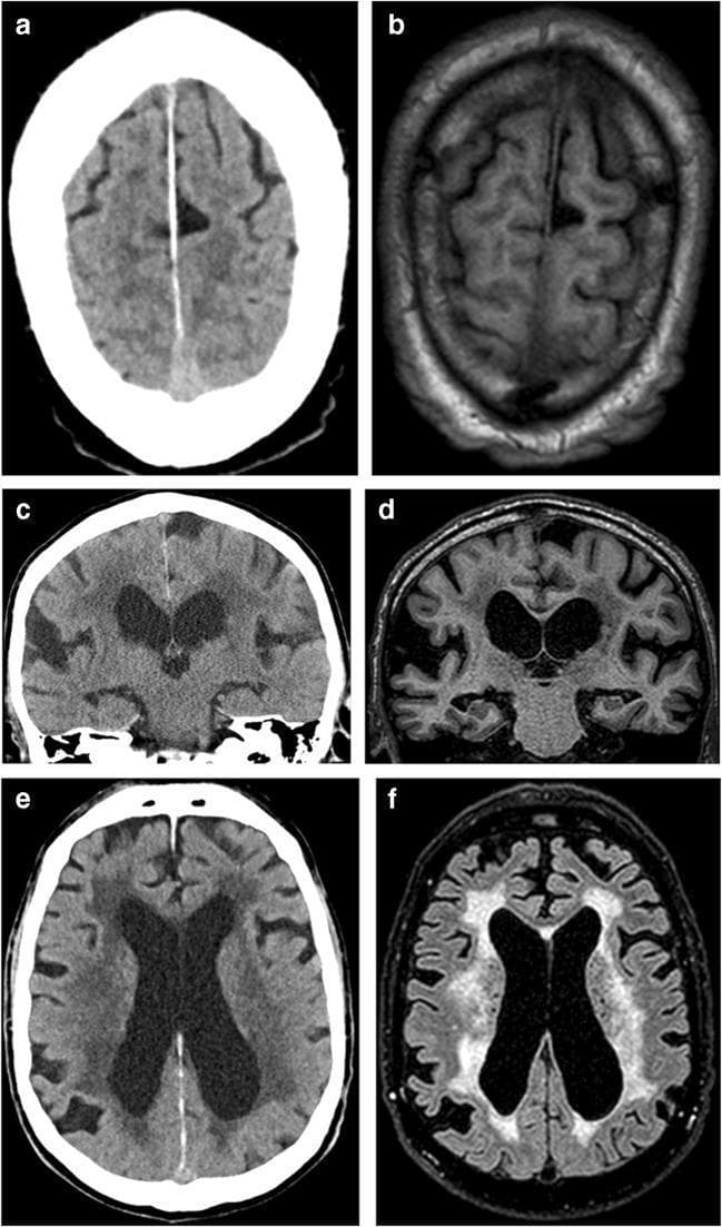 This composite diagnostic image presents a comparative study between Computed Tomography (CT) and Magnetic Resonance Imaging (MRI) of the brain in the context of Idiopathic Normal Pressure Hydrocephalus (iNPH). (a, b) Axial CT and T1-weighted MRI at the vertex level demonstrate 'disproportionately enlarged subarachnoid space hydrocephalus' (DESH), characterized by narrow sulci at the high convexity and midline, contrasting with focally enlarged sulci elsewhere. (c, d) Coronal CT and T1-weighted MRI sections highlight significant ventriculomegaly and prominently dilated Sylvian fissures, a classic diagnostic feature of iNPH. (e, f) Axial CT and T2-FLAIR MRI sequences at the level of the lateral ventricles illustrate extensive periventricular white matter changes. These appear as hypodense regions on CT and hyperintense signals on T2-FLAIR, surrounding the dilated lateral ventricles. The images serve to illustrate how both CT and MRI can identify key morphological markers of hydrocephalus, including sulcal effacement, sylvian fissural widening, and white matter signal alterations for clinical evaluation.