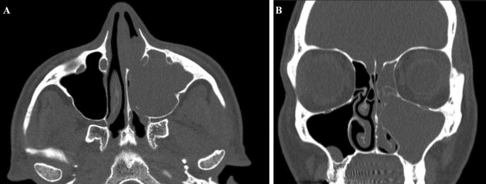 A head computed tomography (CT) scan displaying axial (A) and coronal (B) views of the paranasal sinuses. The imaging reveals a large, soft-tissue density mass measuring approximately 24 mm x 28 mm x 26 mm, which completely obliterates the left maxillary sinus. In both views, the lesion demonstrates expansion into the adjacent nasal cavity and causes total obstruction of the left anterior osteomeatal unit. Secondary findings include mucosal thickening and opacification of the left ethmoid air cells, consistent with secondary ethmoidal sinusitis. The right maxillary and ethmoid sinuses appear clear and well-aerated. This diagnostic image illustrates the radiological presentation of a sinonasal mass, such as an inverted papilloma or other neoplasm, highlighting the resulting regional obstruction and secondary inflammatory changes in the paranasal sinus system. It is an educational example of sinus pathology and the importance of evaluating the osteomeatal complex for obstructive complications.