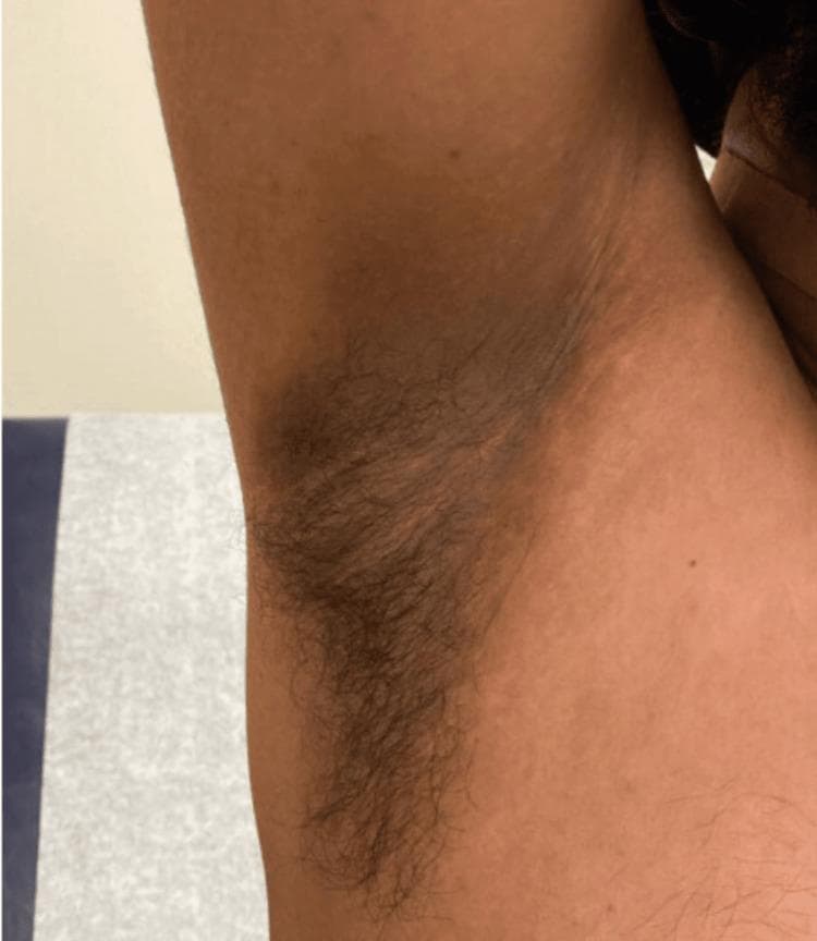 This clinical photograph displays a close-up view of the right axillary region of a patient, demonstrating classic features of acanthosis nigricans. The central axilla shows a poorly demarcated, symmetrical area of hyperpigmentation, characterized by a brownish to grayish-black discoloration that is markedly darker than the surrounding skin. The skin texture within the affected zone appears thickened with a velvety, rugose, or 'dirty' appearance, particularly visible along the natural skin folds. Terminal axillary hair is present, predominantly concentrated over the lower half of the hyperpigmented plaque. The image captures the transition between the medial upper arm and the lateral thoracic wall, providing anatomical context. In a clinical setting, this finding is often associated with insulin resistance, obesity, or certain medications, such as isoniazid as noted in this case, and serves as an important dermatological marker for underlying metabolic or systemic conditions.