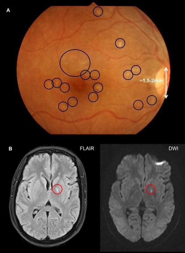 The composite image displays clinical findings in a patient with cerebral malaria, including retinal photography and brain MRI. (A) A fundus retinal photograph showing an orange-hued retina with multiple characteristic lesions of malarial retinopathy. Numerous discrete patches of retinal whitening, ranging from 0.2 to 0.5 mm in diameter, are visible across the macula and fovea (highlighted by black circles). The optic disc is visible at the nasal margin (right) as a reference for scale. (B) Axial brain MRI sections through the level of the basal ganglia. The left image is a T2-FLAIR sequence and the right is a Diffusion-Weighted Imaging (DWI) sequence. Both images demonstrate a focal area of high signal intensity (hyperintensity) in the left globus pallidus (indicated by red circles), representing localized ischemia or edema consistent with cerebral sequestered biomass. These findings illustrate the correlation between microvascular sequestration in the retina and intracranial pathology in severe malaria cases.