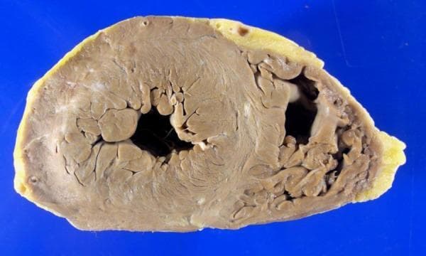 This clinical photograph displays a transverse cross-section (short-axis view) of a human heart specimen at the ventricular level. The specimen illustrates the gross anatomy of both the left and right ventricles. The left ventricular myocardium exhibits mild concentric hypertrophy, characterized by a thickened muscular wall without accompanying cavitary dilation. The myocardium possesses a uniform tan to light brown color and a firm, fibrous texture, showing no visual evidence of acute or chronic myocardial infarction (e.g., discoloration, softening, or white scarring). The endocardial surfaces and trabeculae carneae are clearly visible within the chambers. A thin layer of yellowish epicardial adipose tissue is present on the external surface of the heart. This specimen serves as an educational example of hypertensive or compensatory myocardial changes in the absence of ischemic heart disease.