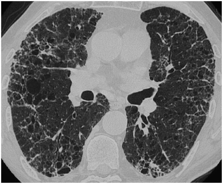 This diagnostic image is an axial high-resolution computerized tomography (HRCT) scan of the thorax, specifically focusing on the lung parenchyma at the level of the lower lobes. The scan demonstrates a Usual Interstitial Pneumonia (UIP)-like pattern in a patient with clinical sarcoidosis. Key visual features include extensive reticulations and traction bronchiectasis (abnormal bronchial widening) within areas of fibrotic change. Characteristic honeycombing is present, appearing as subpleural, clustered cystic airspaces with well-defined, thickened walls. These findings exhibit a distinct basal and peripheral (subpleural) predominance, involving both lungs. This pattern of architectural distortion is representative of advanced pulmonary fibrosis. The educational focus is on identifying atypical presentations of sarcoidosis that mimic UIP, illustrating the transition from granulomatous inflammation to chronic fibrotic disease. This resource is intended for medical students and radiology residents studying interstitial lung disease (ILD) classification and diagnostic imaging.