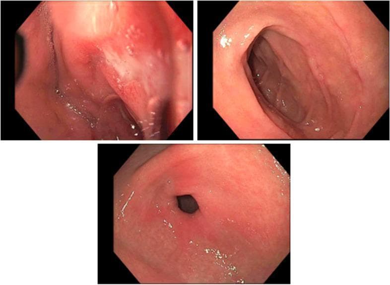 Content Type: Clinical Photograph (Endoscopy). Medical Specialty: Gastroenterology. Target Audience: Intermediate/Advanced. This figure presents three endoscopic views of the upper gastrointestinal tract, specifically capturing the pylorus and the first two segments of the duodenum. The images reveal multiple peptic ulcers characterized as non-bleeding mucosal defects. These lesions demonstrate clean bases (Forrest Class III), meaning they lack stigmata of recent hemorrhage such as adherent clots, visible vessels, or active oozing. The surrounding duodenal and pyloric mucosa appears generally healthy, with a normal pink hue and smooth texture, showing no signs of diffuse inflammation, nodularity, or secondary lesions. The images provide clinical evidence of peptic ulcer disease (PUD) located in the duodenal bulb and sweep, serving as an educational resource for identifying low-risk ulcer morphology during esophagogastroduodenoscopy (EGD) in the context of gastrointestinal bleeding evaluation.
