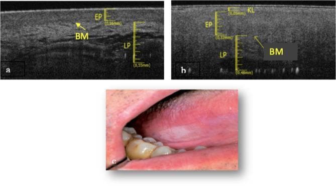 This composite image provides a diagnostic and clinical comparison of healthy tongue mucosa versus oral leukoplakia. Panels (a) and (b) present Optical Coherence Tomography (OCT) scans. Panel (a) shows healthy lateral tongue tissue with a clearly defined, continuous basement membrane (BM), an epithelium (EP) thickness of 0.16 mm, and a deep lamina propria (LP) extending to 0.55 mm. In contrast, panel (b) displays a leukoplakia lesion characterized by a thinner EP (0.05 mm), the presence of a superficial keratin layer (KL), and a disrupted, poorly defined basement membrane with a shallower LP depth of 0.32 mm. Panel (c) is a clinical photograph showing an irregular, opaque white patch on the lateral border of the tongue, consistent with the clinical appearance of leukoplakia. The image demonstrates the use of OCT as a non-invasive tool to visualize microscopic changes in tissue architecture, specifically epidermal thinning and basement membrane fragmentation, which are critical in assessing potentially malignant oral disorders.