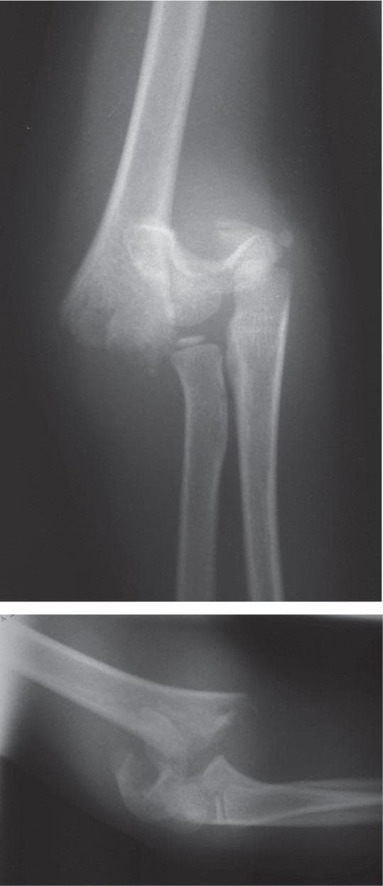 This diagnostic image consists of two radiographic views (anteroposterior and lateral) of a pediatric elbow joint. The X-rays demonstrate a complete, severely displaced supracondylar fracture of the distal humerus, consistent with a Gartland type III classification. The anteroposterior view shows a transverse fracture line through the supracondylar region with significant medial and posterior displacement of the distal humeral fragment. This displacement results in a disruption of the normal anatomical relationship between the distal humerus and the proximal radius and ulna. In the lateral view, there is evidence of posterior angulation and complete lack of cortical contact between the proximal and distal segments. The epiphyses of the distal humerus, radial head, and olecranon are visible, confirming the pediatric nature of the patient. There is associated soft tissue swelling surrounding the elbow joint. Clinically, this imaging represents an orthopedic emergency due to the high risk of neurovascular compromise involving the brachial artery, radial nerve, or median nerve.