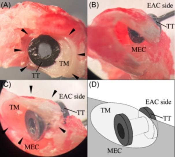 This composite educational resource consists of microscopic images and an anatomical diagram demonstrating the surgical placement of a tympanostomy tube (TT). Figure (A) displays a lateral view of a temporal bone specimen from the external auditory canal (EAC) perspective, showing the black, circular flange of the TT seated flush against the translucent tympanic membrane (TM). Figures (B) and (C) provide cross-sectional and medial views following the opening of the middle ear cavity (MEC), revealing the dual-flange 'spool' design of the tube. The images clearly show the central shaft of the TT penetrating the TM, with one flange anchored in the EAC and the inner flange secured within the MEC to maintain patency. Figure (D) is a schematic illustration summarizing this trans-tympanic placement. This visual is designed for otolaryngology training to illustrate the management of chronic otitis media or Eustachian tube dysfunction through pressure equalization tube insertion, highlighting the anatomical relationship between the external canal, the membrane, and the middle ear space.