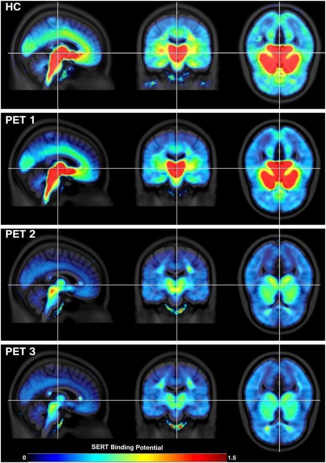 This diagnostic image composite features Positron Emission Tomography (PET) scans illustrating Serotonin Transporter (SERT) availability in the human brain across sagittal, coronal, and axial views. The panels compare a Healthy Control (HC) group with patients with Major Depressive Disorder (MDD) at three intervals: baseline (PET 1), 6 hours post-single dose of a Selective Serotonin Reuptake Inhibitor (SSRI) (PET 2), and after 3 weeks of daily SSRI treatment (PET 3). A colorimetric scale at the bottom indicates SERT binding potential (BPND), ranging from blue (low) to red (high). At baseline (HC and PET 1), high SERT availability is visible in red and yellow within the brainstem (midbrain), thalamus, and subcortical regions, with moderate levels in the cingulate cortex. PET 2 shows a significant reduction in binding potential, represented by a shift toward green and blue, indicating acute SERT occupancy by the SSRI. PET 3 demonstrates sustained and further reduced SERT availability, reflecting long-term therapeutic occupancy. This visual serves as a pharmacological demonstration of antidepressant mechanism of action and brain-wide distribution of serotonin transporters.