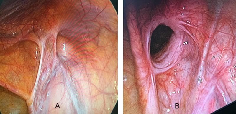 This diagnostic comparison uses laparoscopic (endoscopic) imaging to demonstrate the internal anatomical differences between an indirect and a direct inguinal hernia. Image A displays an indirect inguinal hernia, characterized by a rounded protrusion located lateral to the inferior epigastric vessels. The defect is clearly defined with a localized network of fine vasculature concentrated near the base of the herniated sac. Image B depicts a direct inguinal hernia, presenting as a more diffuse, wide-based bulge through the abdominal wall, located medial to the epigastric vessels in Hesselbach's triangle. The borders of the direct hernia are less distinct than the indirect type, and the overlying peritoneum shows a more prominent, dense, and tortuous vascular network. These images illustrate the surgical perspective during a Transabdominal Preperitoneal (TAPP) repair, emphasizing the importance of anatomical landmarks, specifically the inferior epigastric vessels, in differentiating hernia types based on their exit point relative to the deep inguinal ring.