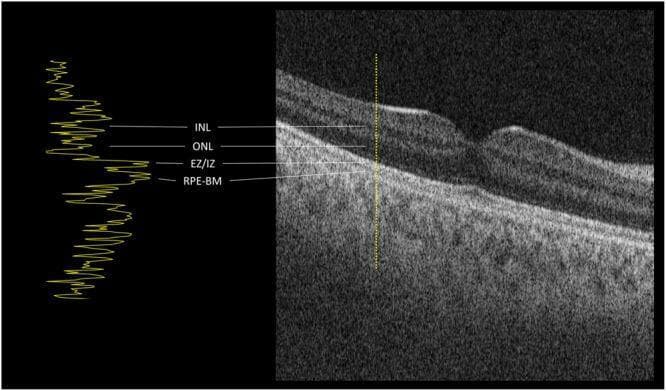 This diagnostic image features a cross-sectional Optical Coherence Tomography (OCT) brightness scan (B-scan) of a normal human macula, paired with an amplitude-scan (A-scan) reflectivity profile. The B-scan illustrates the characteristic anatomical layers of the retina, including the distinct foveal depression. Key labeled structures include the inner nuclear layer (INL), the hypo-reflective outer nuclear layer (ONL), the hyper-reflective ellipsoid zone/interdigitation zone (EZ/IZ), and the highly reflective retinal pigment epithelium-Bruch's membrane complex (RPE-BM). To the left, a corresponding A-scan reflectivity graph plots signal intensity against depth, indicated by a vertical dotted line on the B-scan. The graph's peaks (high reflectivity) and valleys (low reflectivity) correlate precisely with the laminar transitions and internal density of the retinal layers. This visual serves as an educational reference for normal ocular anatomy and the interpretation of OCT signal profiles in ophthalmology, providing a baseline for identifying pathologies like retinal detachment or macular edema.