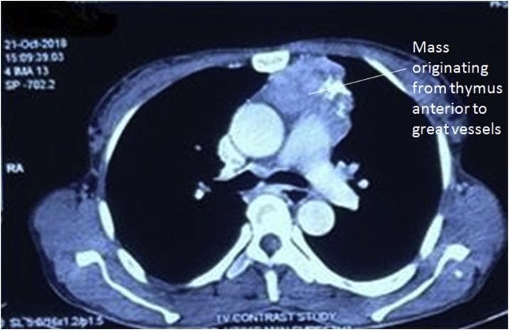 This diagnostic image is an axial contrast-enhanced computed tomography (CT) scan of the thorax at the level of the great vessels. The scan reveals a large, heterogeneously enhancing mass located in the anterior mediastinum. An annotation on the image indicates that the lesion originates from the thymus and is situated immediately anterior to the great vessels, including the ascending aorta and pulmonary trunk. The mass exhibits irregular borders and varying densities, which are characteristic findings for thymic neoplasms such as thymoma. The surrounding anatomical landmarks, including the vertebral body, descending aorta, and sternum, are clearly visible. This clinical image illustrates a common presentation of an anterior mediastinal tumor, often associated with paraneoplastic syndromes like myasthenia gravis. It serves as an educational example for radiological identification of mediastinal compartment pathologies and the evaluation of tumor relationship to vascular structures.