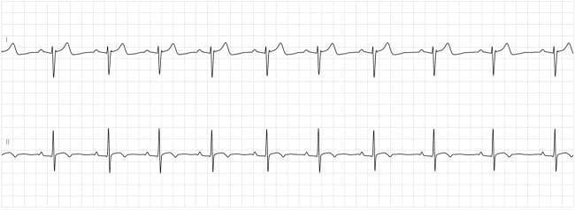 This diagnostic image displays a two-lead electrocardiogram (ECG) rhythm strip, likely from a Holter monitor, showing a regular sinus rhythm. The top tracing (Lead I) and bottom tracing (Lead II) demonstrate consistent PQRST morphology across a standard grid background. Each cardiac cycle consists of a visible P wave preceding a narrow QRS complex, followed by a symmetric T wave. The R-R intervals are regular, indicating a stable heart rate and rhythm. Clinically, this image serves as an educational example of normalized electrical conduction after recovery from high-grade atrioventricular block, specifically in the context of Lyme carditis treatment. The lack of PR prolongation or dropped beats highlights the resolution of the conduction delay. Key educational features include the 1:1 atrioventricular relationship and the absence of morphological abnormalities in the repolarization phase (T waves), confirming clinical stability upon discharge.