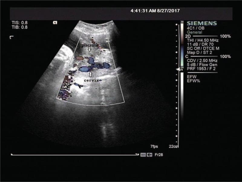 This diagnostic image is a transabdominal obstetric ultrasound with color Doppler, illustrating a longitudinal view of the uterus. The primary focus is on the relationship between the placenta and the cervix. The placenta is shown implanted on the anterior uterine wall; however, its lower edge extends inferiorly to completely cover the internal cervical os, a hallmark sign of placenta previa. The placental parenchyma displays mixed echogenicity with areas of low echoes (lacunae), and the color Doppler overlay reveals significant vascularity in the lower uterine segment near the cervical junction. The surrounding uterine tissue near the cervix appears more heterogeneous and less echogenic than the superior portions of the myometrium. This visual is clinically significant for diagnosing placenta previa, a condition requiring careful management due to the high risk of antepartum and intrapartum hemorrhage. This content is suitable for intermediate to advanced medical learners studying obstetrics and fetal imaging.