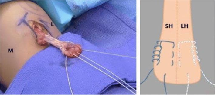 A composite image consisting of an intraoperative photograph (left) and a corresponding anatomical diagram (right) focusing on orthopedic surgical repair of the distal biceps tendon. The clinical photograph displays a surgical incision at the antecubital fossa with the distal biceps tendon exteriorized. The tendon is bifurcated into two distinct heads, labeled 'M' for medial and 'L' for lateral in the surgical field. Suture material is shown interlaced through each tendon head using a four-throw modified Krackow whipstitch technique, with long suture leads extending distally for eventual reattachment to the radial tuberosity. The anatomical diagram on the right provides a schematic representation of this technique, labeling the bifurcated tendon as 'SH' (short head) and 'LH' (long head). It illustrates the specific looping and locking mechanism of the Krackow stitch on each side of the tendon mid-substance, emphasizing the anatomical separation of the bifid distal biceps for anatomic footprint restoration during surgical reattachment.