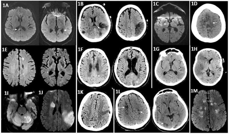 A multi-panel figure consisting of axial non-contrast Computed Tomography (CT) scans and Diffusion-Weighted Magnetic Resonance Imaging (DWI-MRI) showing various patterns of acute and subacute ischemic stroke in the brain. The CT images (B, D, F, G, H, K, L) demonstrate areas of hypodensity indicating cytotoxic edema or established infarction, notably involving the middle cerebral artery (MCA) and anterior cerebral artery (ACA) territories, with some cases showing large territorial infarcts (H) and others showing bilateral involvement (B, L). The MRI panels (A, C, E, I, J, M) utilize diffusion-weighted sequences to highlight acute ischemic lesions as bright hyperintensities, reflecting restricted water diffusion. Anatomical regions affected include the frontal, temporal, parietal, and occipital lobes, as well as the cerebellum (I), corpus callosum (A), and deep white matter structures such as the corona radiata and centrum semiovale (M). These images illustrate both focal and multifocal (embolic-type) patterns of cerebral infarction, serving as a comparative educational resource for neuroimaging modalities in vascular neurology.