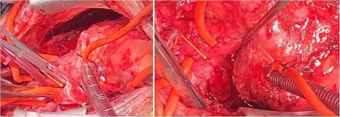 Two intraoperative clinical photographs demonstrate a bidirectional Glenn procedure (superior cavopulmonary anastomosis) in a pediatric surgical field. The images show the end-to-side anastomosis where the superior vena cava (SVC) has been surgically joined to the right pulmonary artery (RPA). Surgical instruments, including metal forceps and needle holders, are positioned around the vascular structures. Fine prolene sutures are visible at the anastomosis site, indicated by yellow arrows. The operative field includes various specialized equipment: a transparent measuring suction tip with metric markings (millimeter scale) for sizing, and multiple small-diameter orange silastic cannulas/perfusion lines. Corrugated bypass tubing and metallic retractors are also present at the periphery. This procedure aims to redirect deoxygenated blood from the upper body directly to the lungs, bypassing the right heart in the setting of right ventricular hypoplasia and severe tricuspid stenosis. The visual focus is on the vascular reconstruction and the precise surgical technique required for congenital heart disease correction.