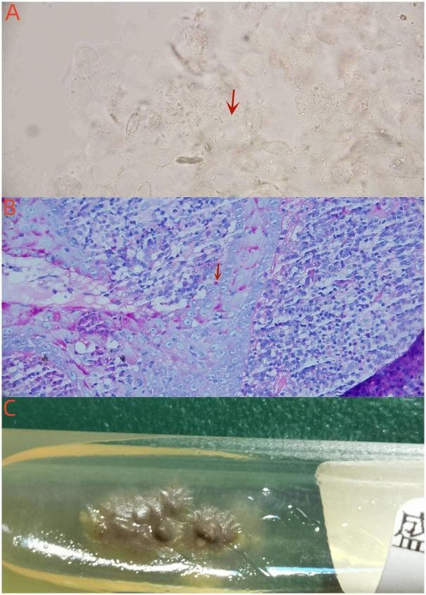 A composite image illustrating the diagnostic mycological and histopathological features of Sporothrix globosa. Panel A (Microscopy): Direct microscopy of an exudate smear using a 10% KOH preparation (400x) reveals slender, translucent, thread-like hyphae (indicated by a red arrow) against a cleared background of squamous cells. Panel B (Pathology): A high-magnification histopathological section (1000x) with Periodic Acid-Schiff (PAS) staining demonstrates intracellular fungal spores (indicated by a red arrow) localized within a multinucleated giant cell, surrounded by a dense inflammatory infiltrate. Panel C (Microbiology): A macroscopic photograph of a fungal culture on a Sabouraud dextrose agar (SDA) slant after 9 days of incubation at 25°C. The culture shows characteristic brownish-beige, moist colonies with a wrinkled, irregular, and slightly raised texture typical of Sporothrix species. This collection of images summarizes the laboratory findings necessary for diagnosing cutaneous disseminated sporotrichosis in a clinical setting.