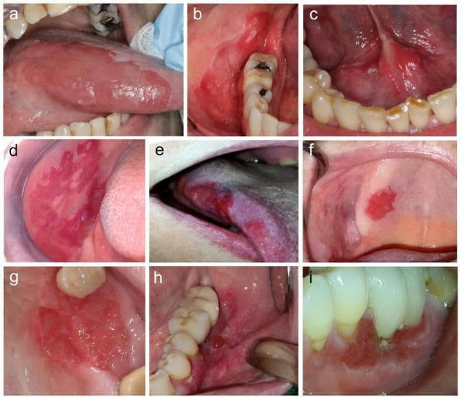 A composite of nine clinical intraoral photographs (labeled a-i) showing various presentations of oral erythroplakia-like squamous cell carcinoma (OELSCC). The images demonstrate a range of erythematous lesions located across various oral sites, including the gingiva, lateral tongue, floor of the mouth, and buccal mucosa. Visually, the lesions are characterized by a predominant bright red color, with some exhibiting minor white leukoplakic patches or focal ulceration. Morphological features include matte to shiny textures and surfaces that range from smooth and flat to granular or uneven. Some lesions are clearly depressed relative to the surrounding healthy mucosa. While most lesions display well-defined, sharp borders—a key clinical feature distinguishing them from diffuse inflammatory conditions—others show more poorly defined margins. This educational compilation illustrates the subtle clinical variations of high-risk red oral lesions that may harbor invasive malignancy, emphasizing the importance of detailed visual assessment in oral pathology and oncology.