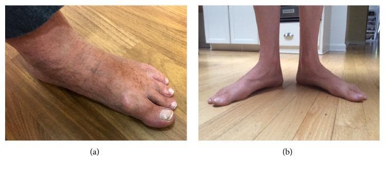 This comparative clinical photograph displays two different presentations of pes planus (flat feet). Panel (a) is a lateral-oblique view of a right foot showing a significantly collapsed medial longitudinal arch with the midfoot in contact with the floor. The skin exhibits mottling, venous prominence, and hyperpigmentation, with thickening and discoloration of the hallux nail. Panel (b) is an anterior view of both feet in a weight-bearing position, demonstrating bilateral flattening of the arches accompanied by a valgus alignment at the ankles and abduction of the forefeet. While both cases illustrate characteristic arch collapse, panel (a) shows additional dermatological and vascular changes, whereas panel (b) highlights postural and structural malalignment associated with the condition. These images are used in medical education to illustrate the musculoskeletal morphology of flat feet and their potential association with hereditary neuropathies like Charcot-Marie-Tooth disease (CMT).