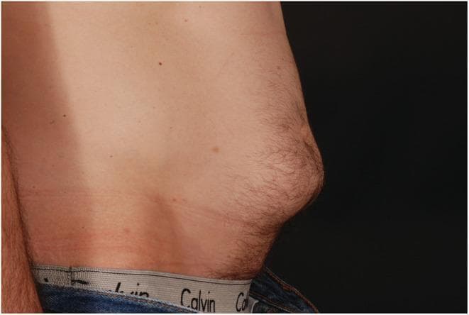 Clinical photograph providing a lateral view of a male torso in an upright position, demonstrating severe insulin-induced lipohypertrophy. The image captures a prominent, circumscribed protrusion of subcutaneous adipose tissue in the lower lateral abdomen. This localized bulge disrupts the natural contour of the abdominal wall, presenting as a firm, raised mass several centimeters in diameter. The overlying skin appears intact and smooth, though it exhibits terminal hair growth consistent with the patient's demographics. Minor skin findings include scattered nevi and faint horizontal skin creases from posture. This visual serves as a classic clinical example of a common complication in patients with long-standing type 1 diabetes who repeatedly inject insulin into the same site. The educational focus is on the physical manifestation of lipohypertrophy, which can impair insulin absorption and lead to poor glycemic control, as seen in clinical scenarios like diabetic ketoacidosis (DKA).
