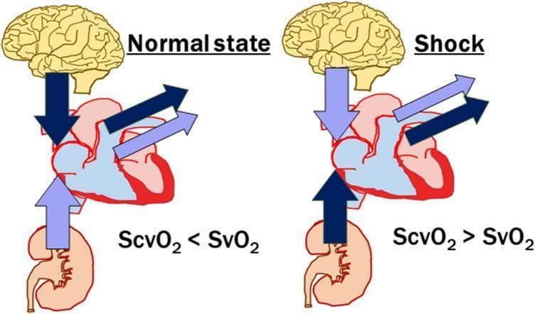 This pathophysiology diagram illustrates the differences in regional oxygen saturation and blood flow distribution between a normal physiological state and circulatory shock. The diagram features anatomical icons of the brain, heart, and kidney, with arrows representing venous return and mixed venous output. In the 'Normal state,' the venous return from the brain is shown with a dark blue arrow (high extraction), while the return from the kidney is pale purple (low extraction), resulting in the relationship ScvO2 < SvO2. Conversely, in the 'Shock' state, the centralization of circulation is depicted: the kidney return becomes dark blue (indicating increased extraction or decreased perfusion), and the brain return becomes pale purple, leading to the inversion ScvO2 > SvO2. The comparison highlights how circulatory failure and compensatory vasoconstriction in visceral organs alter the balance between central venous oxygen saturation (ScvO2) and mixed venous oxygen saturation (SvO2), serving as a critical indicator for monitoring tissue perfusion and cardiac output adequacy in critical care settings.